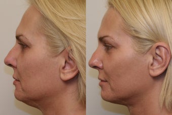 Ultherapy