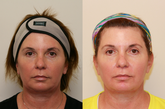 Ultherapy Lower Face