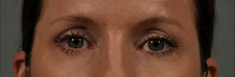 Ultherapy