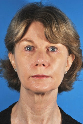 Ulthera and Sculptra