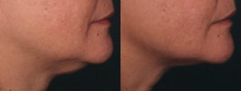 Ulthera Laser Skin Tightening