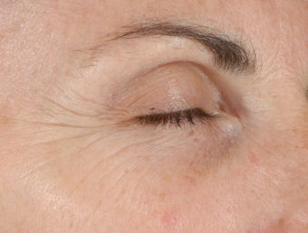 Ulthera Laser Skin Tightening