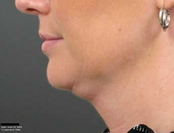 Ulthera Laser Skin Tightening