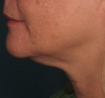 Ulthera Laser Skin Tightening