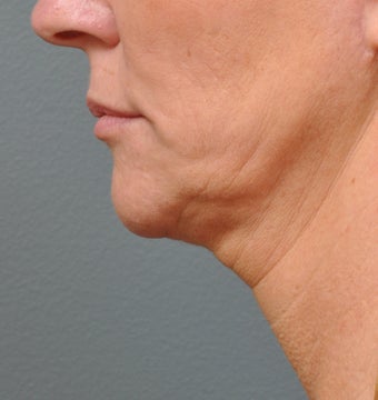 Ulthera Laser Skin Tightening