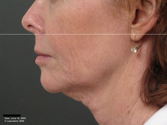 Ulthera Laser Skin Tightening