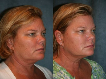 Ultherapy