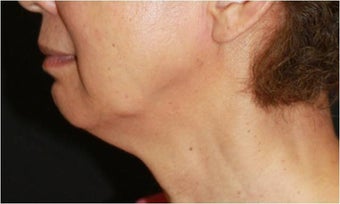Ultherapy