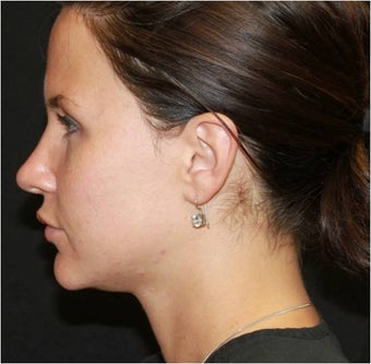 Ultherapy