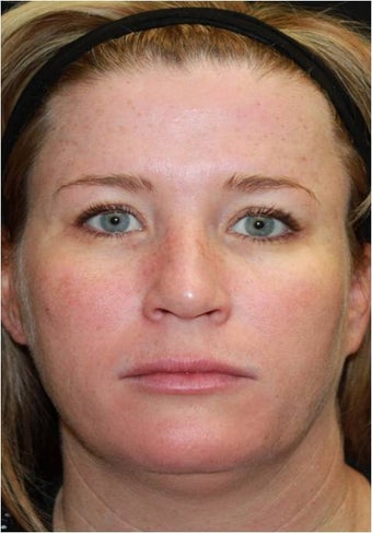 Ultherapy