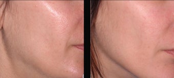 Ultherapy