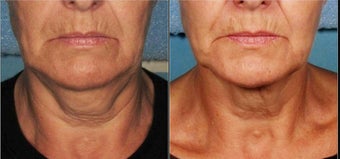 Ultherapy