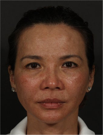Ultherapy