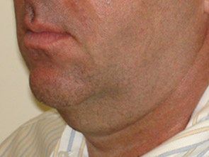 Ultherapy