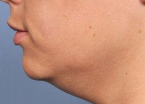 Ultherapy