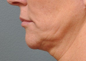 Ultherapy