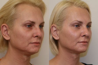 Ultherapy
