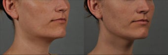 Ultherapy