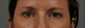 Ultherapy
