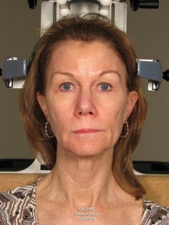 Ulthera and Sculptra