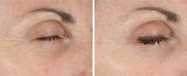 Ultherapy of Eyes and Neck