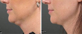 Ultherapy