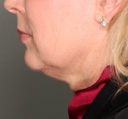Ultherapy