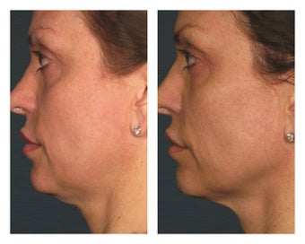 Ultherapy