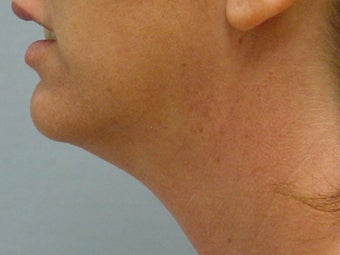 Ultherapy of Face