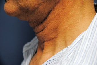 Ultherapy - immediately before and after