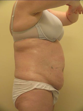 Ultrashape