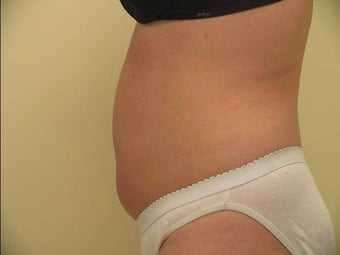 Ultrashape