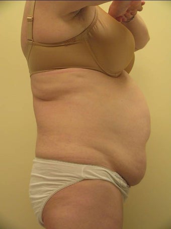 Ultrashape