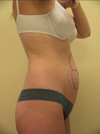 UltraShape