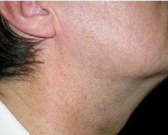 VBeam treatment for neck redness