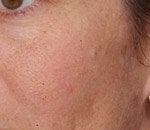 V Beam treatment for Rosacea