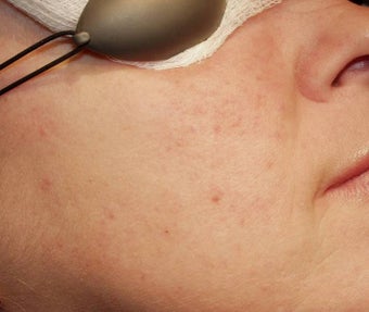 Vein Treatment