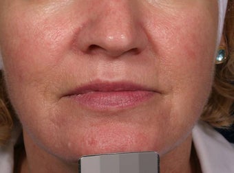 Vein treatment