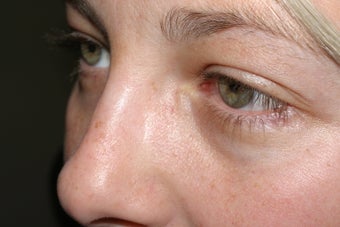 Vein treatment