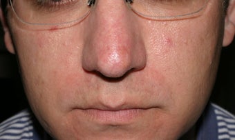 Vein treatment