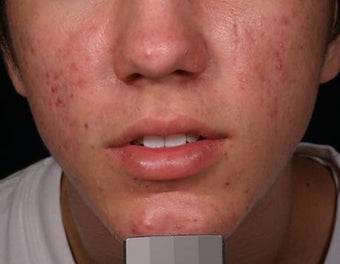 Acne laser treatment with PDT
