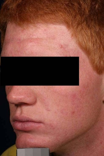 Acne laser treatment with photodynamic therapy
