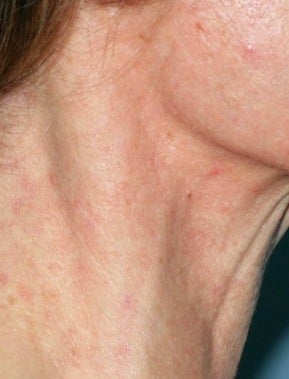 Vbeam laser treatment