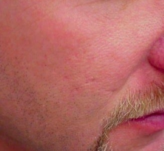 Vbeam treatment for scars