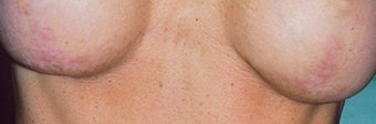 Breast implant scar removal