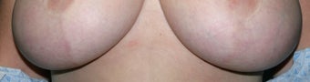 Laser treatment for breast implant scars