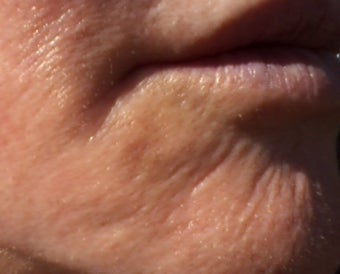 V Beam treatment of a bruise