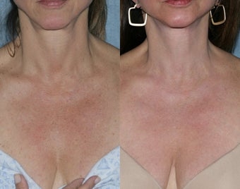Fraxel Repair with Vbeam Perfecta and Alexandrite Lasers