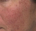 V Beam treatment for Rosacea