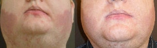 Treatment for port wine stain